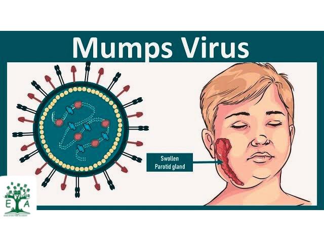 MUMPS DISEASE